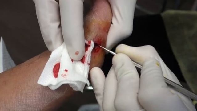 EXTREME FOOT INJURY UNBELIEVABLE REMOVAL!!! WHAT’S STUCK IN THIS FOOT??? FOOT HEALTH MONTH 2018 #15 смотреть онлайн