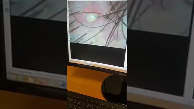 Гнойники на коже головы смотреть онлайн