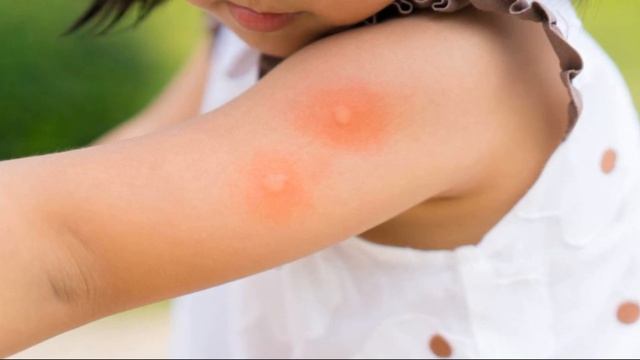 УКУСЫ ВШЕЙ, БЛОХ И КЛОПОВ | Какими инфекциями они опасны смотреть онлайн