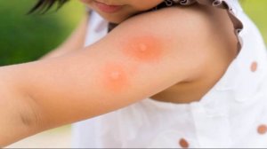 УКУСЫ ВШЕЙ, БЛОХ И КЛОПОВ | Какими инфекциями они опасны