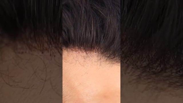 #hairfixinginbangalore | most Natural Hairline Hair patch| #Arthahairfixing Call 9110221804 смотреть онлайн
