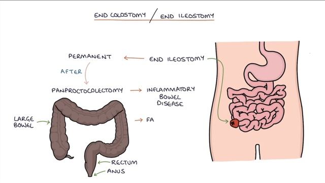 Understanding Stomas (Colostomy, Ileostomy, Urostomy and Gastrostomy) смотреть онлайн