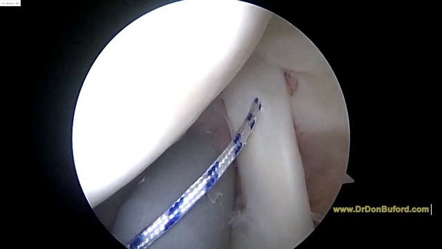 L Shoulder Biceps Tenodesis 2018 10 11 PB смотреть онлайн