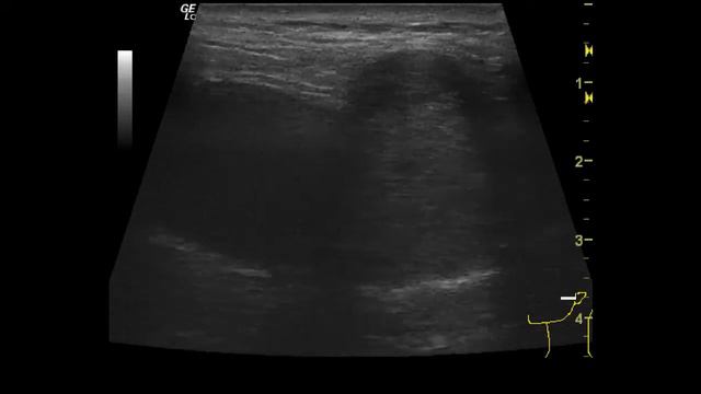 Аденома слюнной железы смотреть онлайн