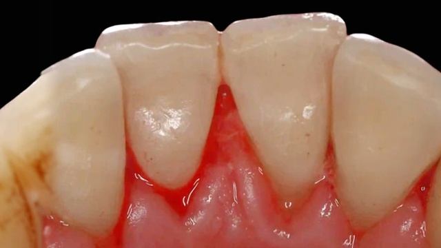 Как вам такое до/после чистки зубов? #чистка #зубыдоипосле смотреть онлайн