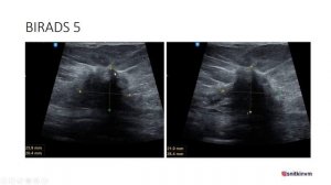 Классификация BIRADS (БИРАДС, БАЙРАДС) в практике врача ультразвуковой диагностики. Часть 2.