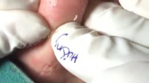 ВЫДАВЛИВАНИЕ ЧЕРНЫХ ТОЧЕК НОВОЕ 2019