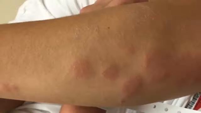 Bedbugs: How they hide and bite | Bed Bugs what to do | Bugs that bite смотреть онлайн