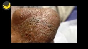 Выдавливание прыщей косметологической петлей