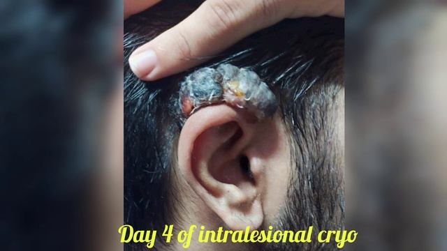 Intralesional cryotherapy for ear keloid | Keloid treatment | Cryospray at @ankurtalwar5039 смотреть онлайн