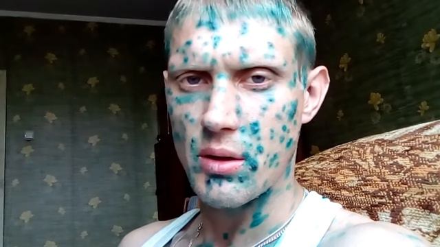 Ветрянка (2-ой день) смотреть онлайн