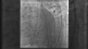 Как проводится коронарография видео