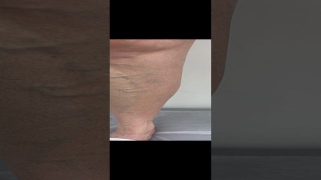 Варикозная болезнь. Как лечить варикоз? Сосудистый хирург. Флеболог. Флеболог Москва смотреть онлайн