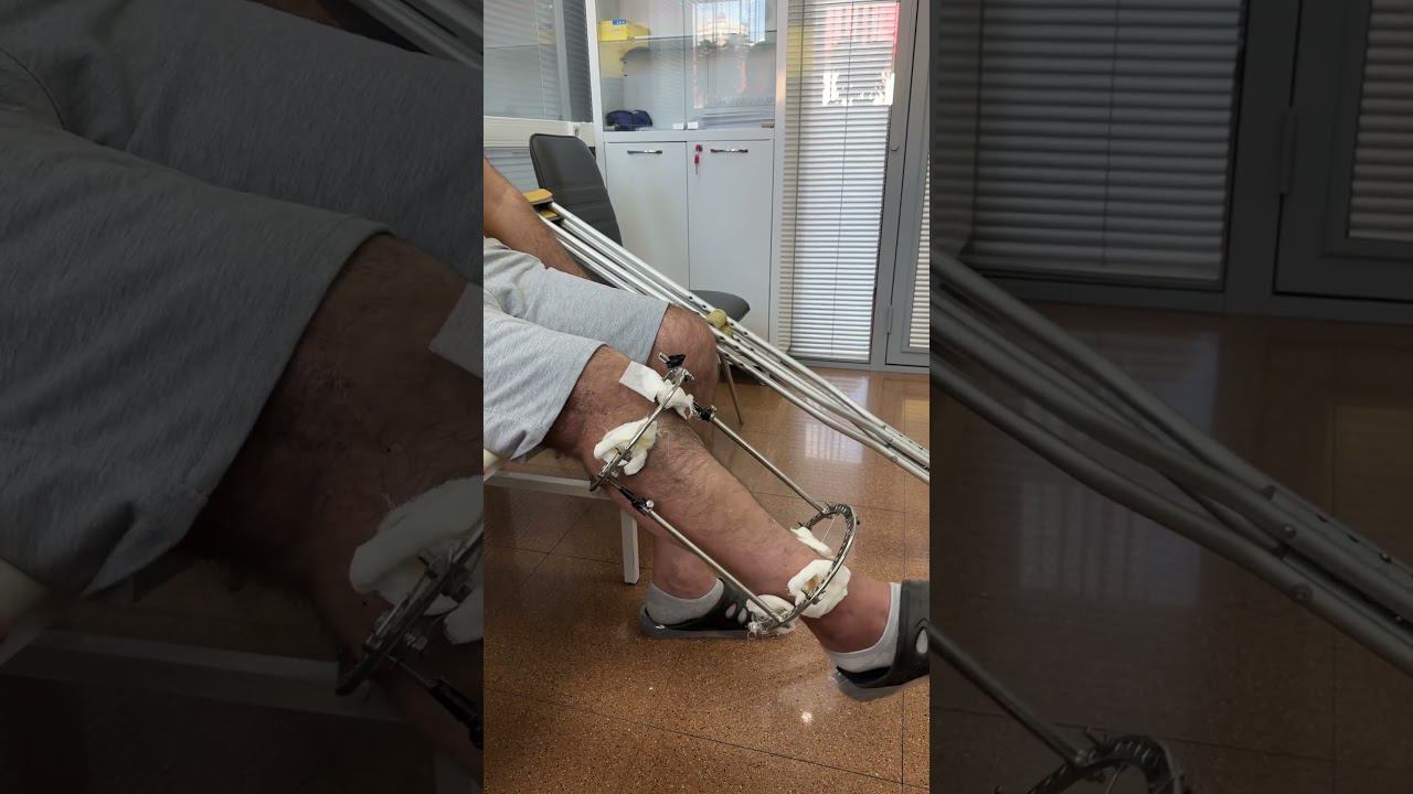 Доктор на Работе | Восстанавливаем Квадрицепс | 6 операций на Ноге смотреть онлайн