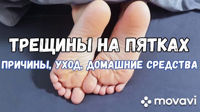 КАК СПРАВИТЬСЯ С ТРЕЩИНАМИ НА ПЯТКАХ. Причины, уход, домашние средства. смотреть онлайн