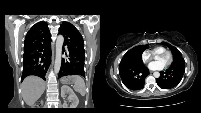 Mediastinal CXR anatomy смотреть онлайн