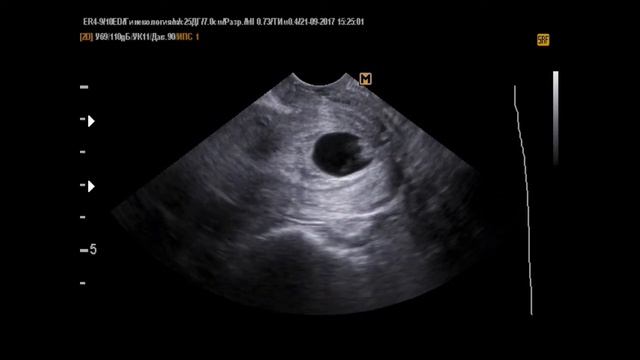 Аборт в ходу, неразвивающаяся беременность 6 нед на УЗИ смотреть онлайн