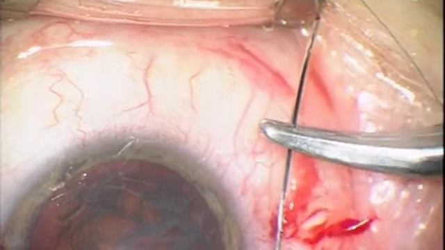 Malyugin/Cionni CTR | Preloaded Capsular Tension Ring | Features & Procedure | FCI Cataract смотреть онлайн