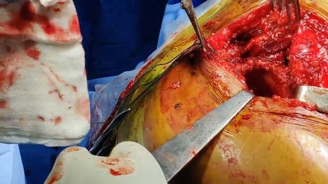 Uncemented Total Hip Replacement Surgery (Posterior Approach) смотреть онлайн