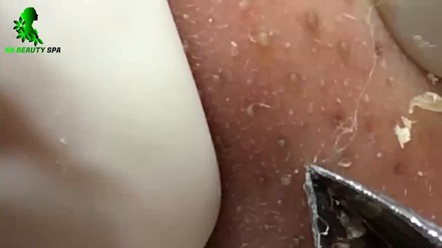 角栓 ブラックヘッド 角栓除去 ニキビ芯出し | ーニキビ #にきび治療 #BlackHeads #Whiteheads #Acnes #Dr Chong Clinic