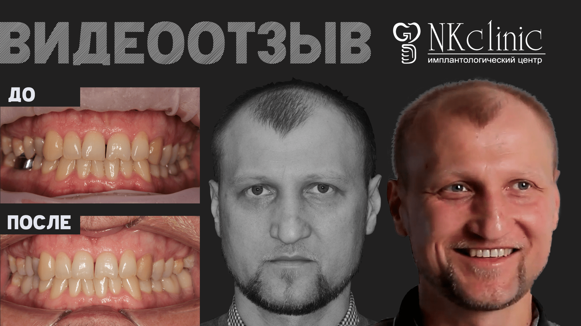 NKclinic - отзывы пациентов. Кисты на корнях зубов, удаление 8-ок, имплантация и установка коронок