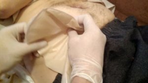 Замена калоприемника #2