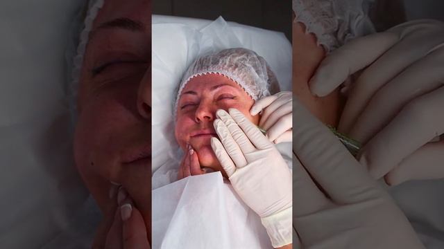 Локальная коррекция объема мягких тканей с помощью мезонитей-волюметриков: Сетки, Кисти, Филлеры смотреть онлайн