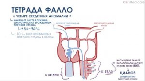 Тетрада Фалло