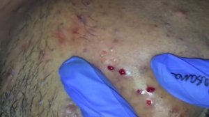 BEST ACNE TREATMENT with BLACKHEAD REMOVAL PART   2 BY POPPING KING DR.LALIT KASANA