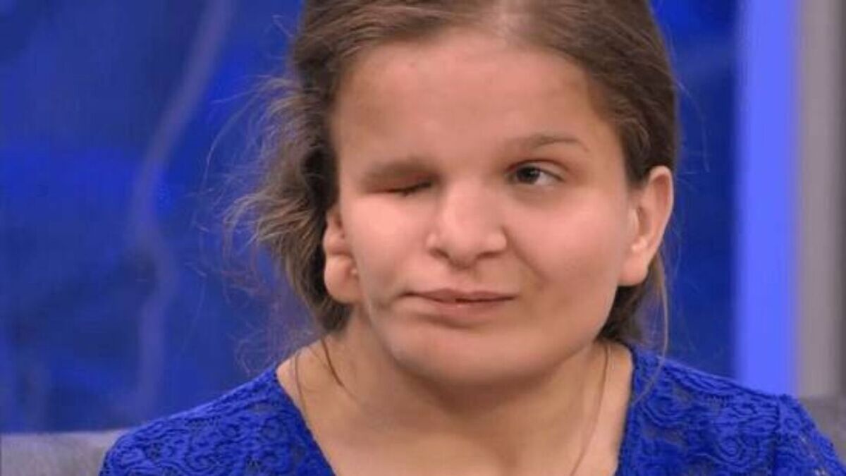 Что стало с 17-летней Катей Бадаевой с дефектом лица из «Пусть говорят» смотреть онлайн