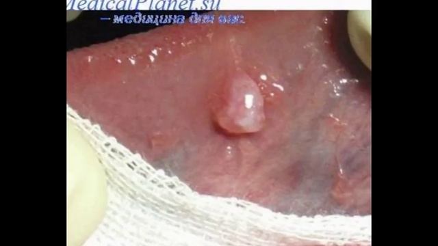 Киста яичника народные рецепты смотреть онлайн