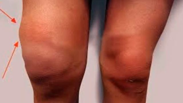 ★ Как избавиться от отеков и лишней жидкости в организме. Отечность лица и тела. смотреть онлайн