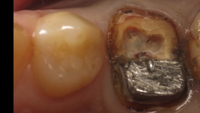 Cast Post Removal / Извлечение культевой вкладки смотреть онлайн
