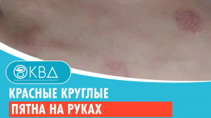 ? Красные круглые пятна на руках. Клинический случай №794