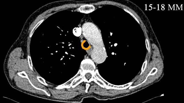 Трахея и главные бронхи анатомия / Компьютерная томография / Рентгенология смотреть онлайн