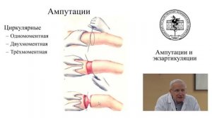 Ампутация и экзартикуляция