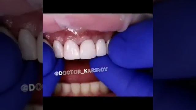 Виниры Керамические. Примерка смотреть онлайн