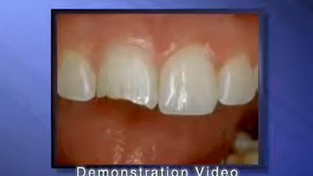 Бруксизм - скрежетание зубами смотреть онлайн