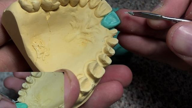 Моделировка зубов. Как моделировать центральный резец? Серия видео моделировки верхних зубов. смотреть онлайн