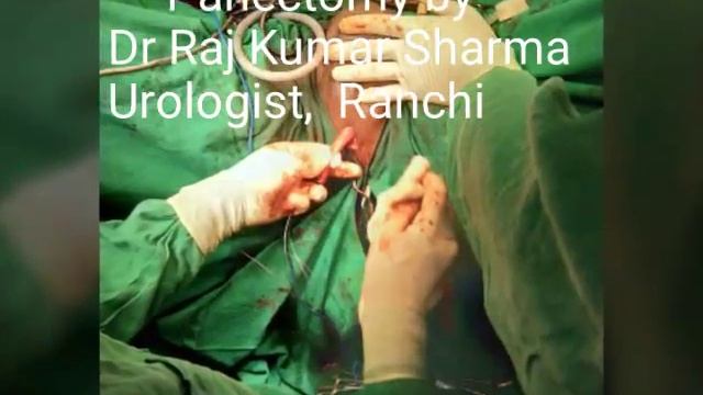 Panectomy With Bilateral Modified Inguinal Lymph Nodes Resection By Urologist Dr Raj Kumar Sharma