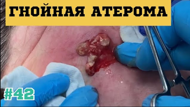 42. Вскрытие гнойной атеромы #42