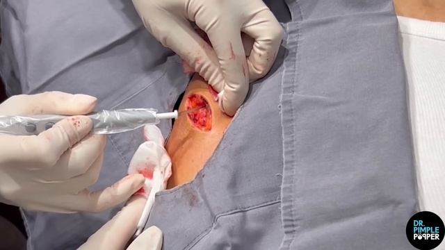 Upper Arm Lipoma Surprise смотреть онлайн