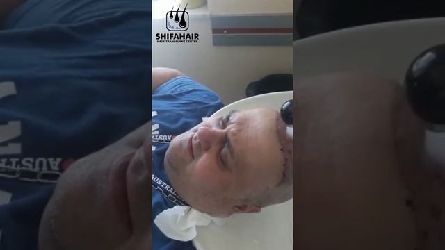 Мытье головы после пересадки волос на 3 день смотреть онлайн