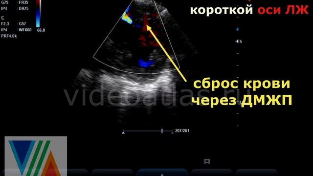 Верхушечный ДМЖП смотреть онлайн