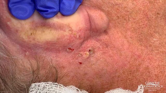 Blackhead Comedones Extraction Party Behind the Ear смотреть онлайн