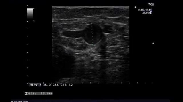 Широкое состоятельное устье БПВ смотреть онлайн