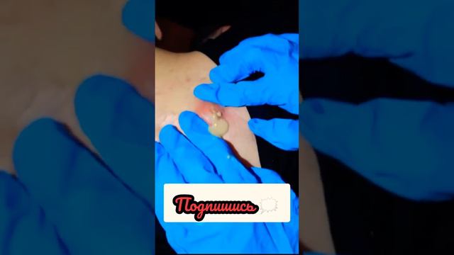 #прыщи смотреть онлайн