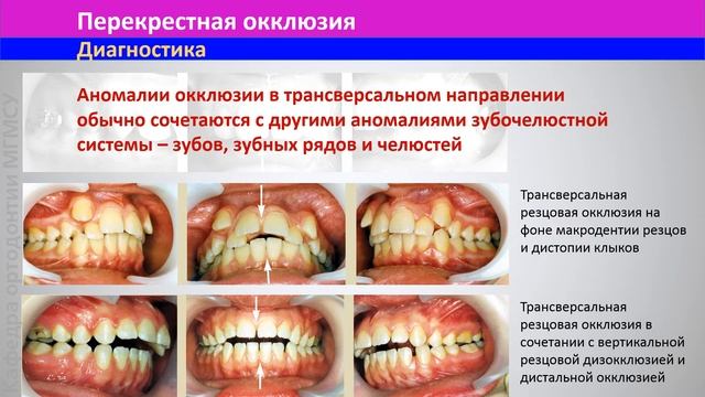 5.4 Аномалии окклюзии по трансверсали смотреть онлайн