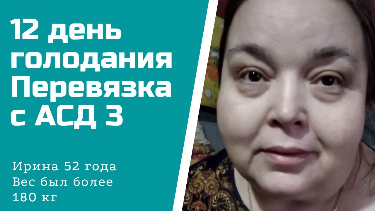 Вес 180 кг.12 день голодания. Перевязка с АСД 3.mp4 смотреть онлайн
