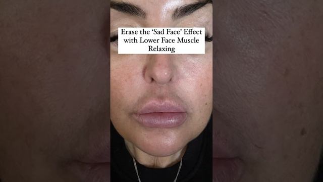 Erase the ‘Sad Face’ Effect with Lower Face Muscle Relaxing #sadface #botox смотреть онлайн